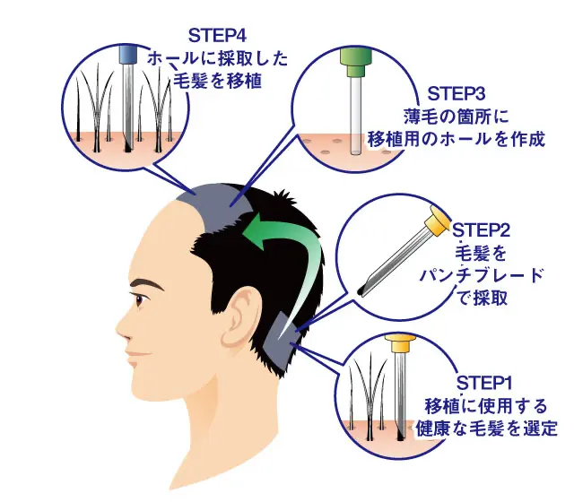 自毛植毛